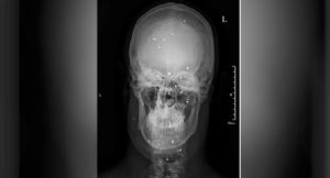 shahin-balles-de-plombs-iran-csdhi